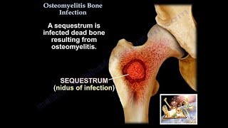 Osteomyelitis Bone Infection  Everything You Need To Know  Dr Nabil Ebraheim [upl. by Ahsinrac990]