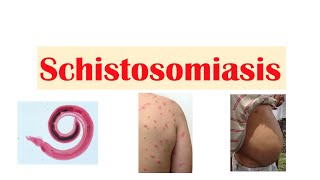 Schistosomiasis  Bilharziasis  Causes Symptoms and Treatment [upl. by Dermott]