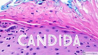 Candida Yeast Infection under microscope Candidiasis Dermatology Dermatopathology [upl. by Iong]