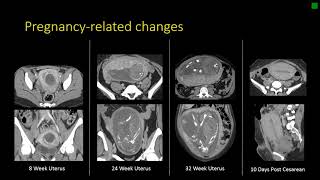 Gynecologic Radiology Anatomy [upl. by Jaime]