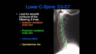 Radiology of Spine Trauma [upl. by Auqenahs]