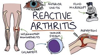 Understanding Reactive Arthritis [upl. by Nnaeiram]