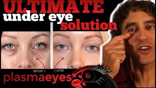 THE ULTIMATE UNDER EYE TREATMENT  PlasmaEyes [upl. by Fagin]