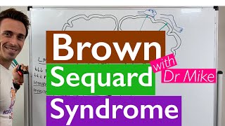 Brown Sequard Syndrome [upl. by Kceb]