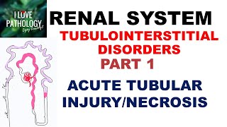 ACUTE TUBULAR INJURYNECROSIS or ACUTE KIDNEY INJURY  Pathology [upl. by Anaidiriv]