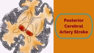 Posterior Cerebral Artery Stroke [upl. by Aicerg752]