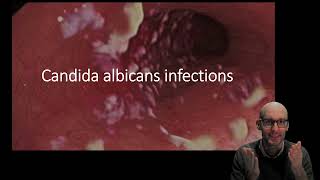 Candida albicans infections [upl. by Eneryt]