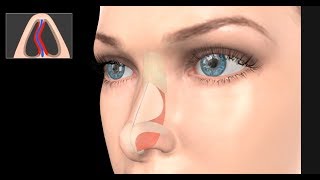 Deviated Septum Surgery Septoplasty [upl. by Ynelram]