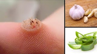 How To Remove Warts At Home Naturally [upl. by Airrehs]