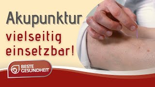 Akupunktur vielseitig einsetzbar [upl. by Nerta]