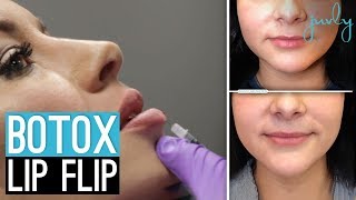 BOTOX BROW LIFT My Results and How Much I PAID [upl. by Mcknight995]