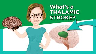 Thalamic Stroke [upl. by Hasile]