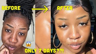 HOW I CLEARED MY SKIN in 1 WEEK and LIGHTENED my dark under eye circles [upl. by Vudimir859]