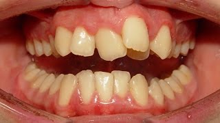 Severe Crowding Treatment with Damon System  Senda 15years [upl. by Diskson304]