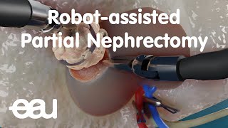 Robotassisted Partial Nephrectomy RAPN [upl. by Clyde]