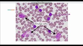 Chronic Lymphocytic Leukemia CLL [upl. by Marentic]