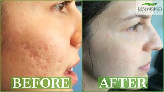 ICE PICK SCAR Acne Results Testimonial  TCA CROSS  Dr Ben Behnam  Los Angeles [upl. by Kcireddor]