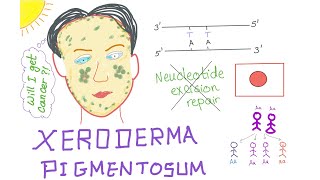 Xeroderma Pigmentosum [upl. by Ellga]