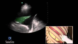 How To Ultrasound Guided Thoracentesis Exam 3D Video [upl. by Lovering60]