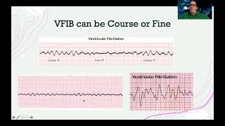 EKGVentricular Dysrhythmias [upl. by Bianchi106]