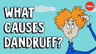 What causes dandruff and how do you get rid of it  Thomas L Dawson [upl. by Iveson]