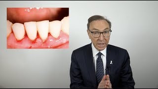 How to Treat Bleeding Gums at Home [upl. by Miranda129]