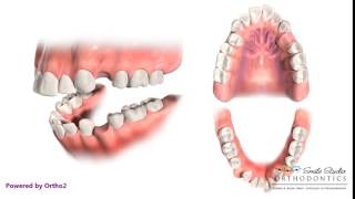 4 First Premolar Extraction for Retraction  Orthodontic Treatment [upl. by Eidroj]