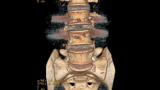 A Case of Double Failed Lumbar Fusion and Dangerously Misplaced Pedicle Screws [upl. by Ramedlaw]