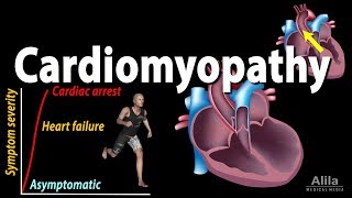 Cardiomyopathy animation [upl. by Dora]