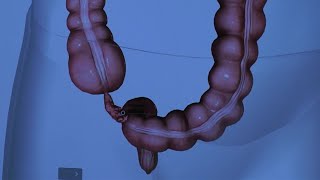 Appendicitis Causes Signs and Symptoms Diagnosis and Treatment [upl. by Voccola]