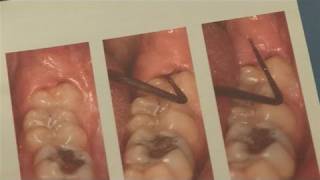 How To Alleviate Infected Wisdom Tooth [upl. by Clemente]